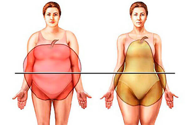 Tipos de obesidad.