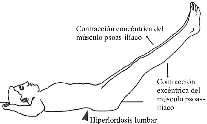 Hiperlordosis lumbar.