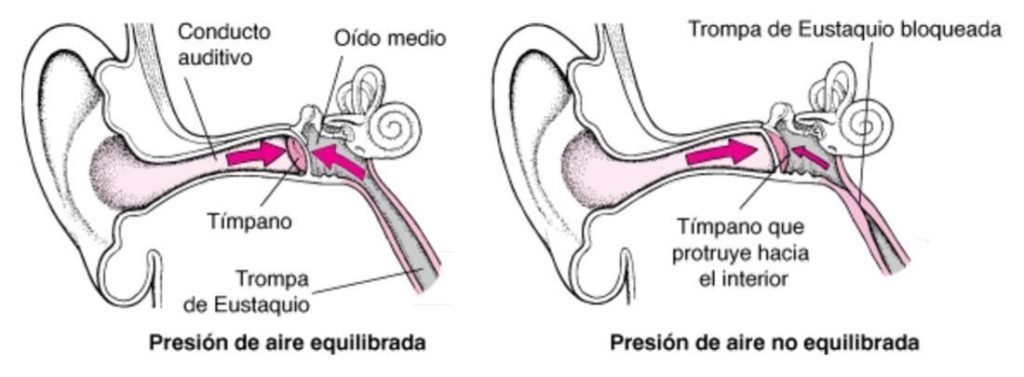 Barotrauma de oído medio