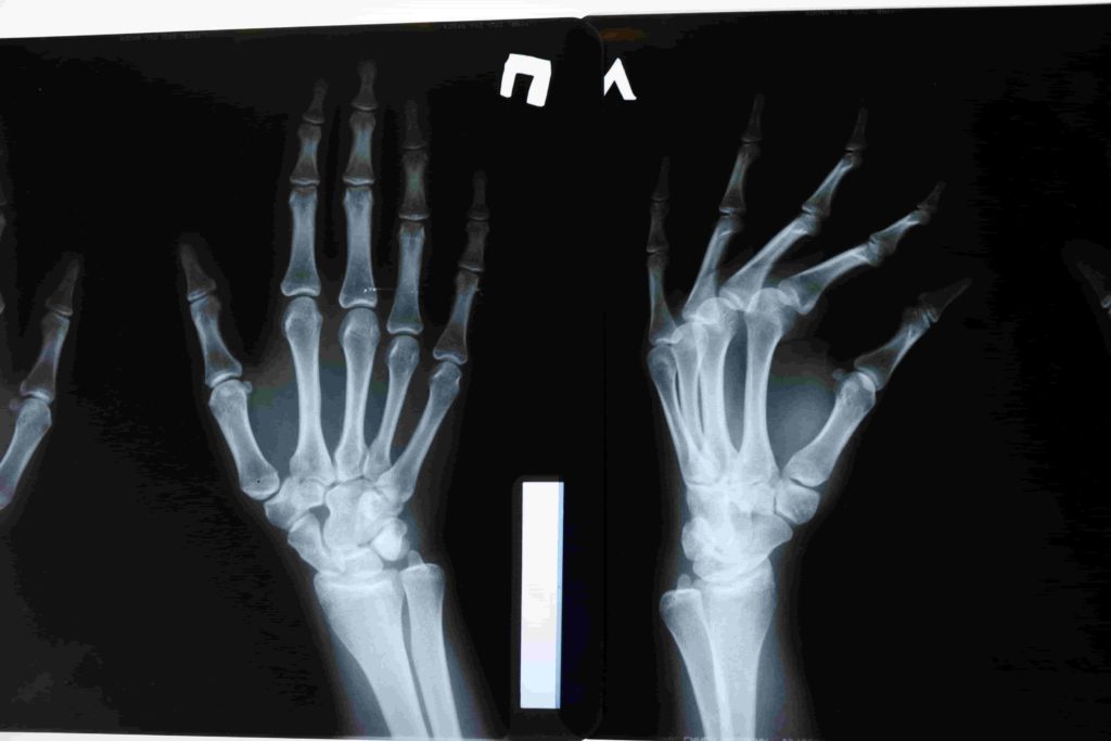 Es necesario tomar radiografías para el tratamiento de lesiones en MMA