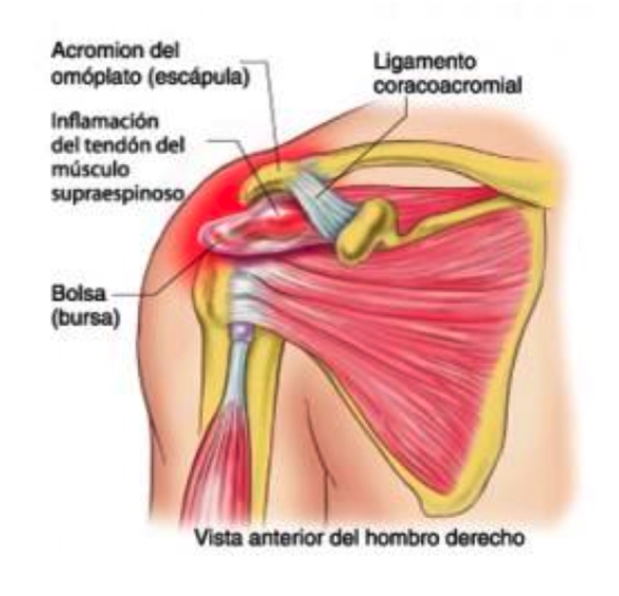 Lesiones deportivas de hombro: tendinopatías.