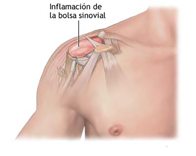 Síndrome subacromial del hombro.
